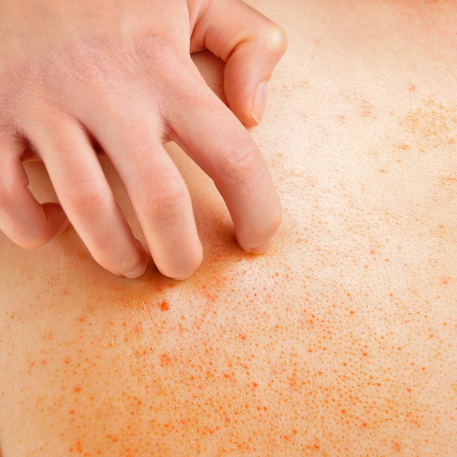 Best Korean Eczema Cream and Skincare for Dermatitis (or eczema)