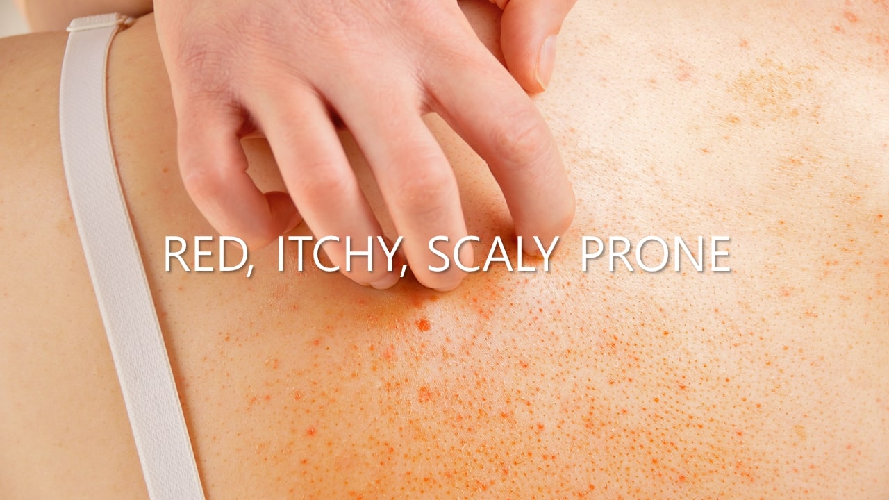 Best Korean skincare for eczema